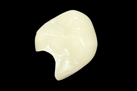 秩父郡・おこのぎ歯科医院・セラミックインレー