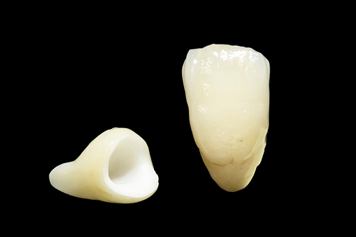 秩父郡・おこのぎ歯科医院・ジルコニア