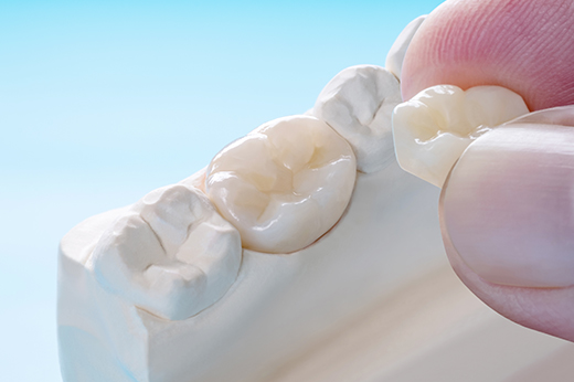 秩父郡・おこのぎ歯科医院・セレックシステムのメリット